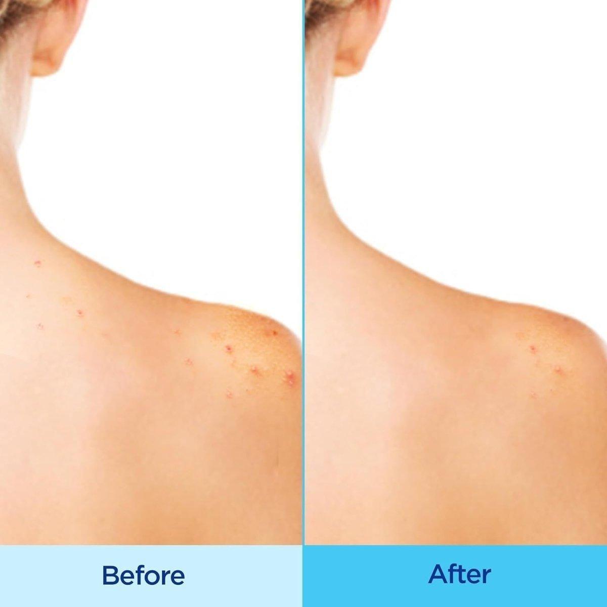Acne Treatment Body Spray for Clear Skin - 180ml