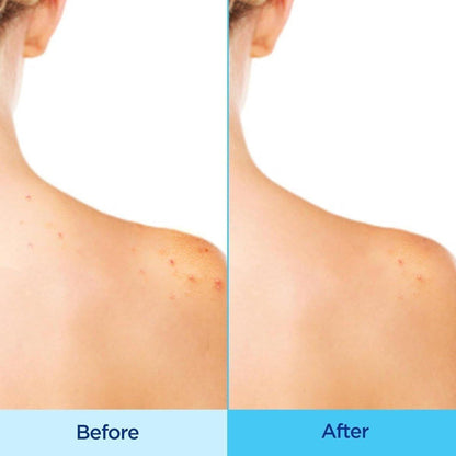 Acne Treatment Body Spray for Clear Skin - 180ml
