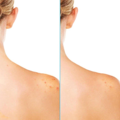 Acne Treatment Body Spray for Clear Skin - 180ml