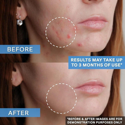 Effective Acne Treatment Gel for Clear Skin - 50ml