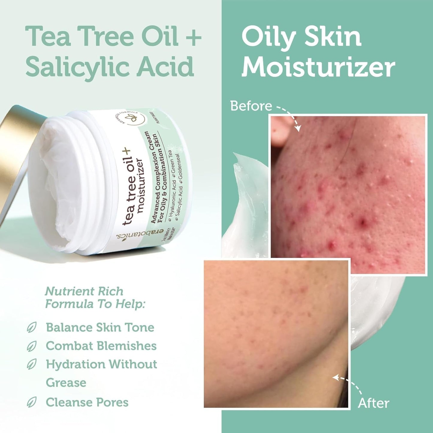 Natural Tea Tree Oil Face Cream - Acne Control Moisturizer