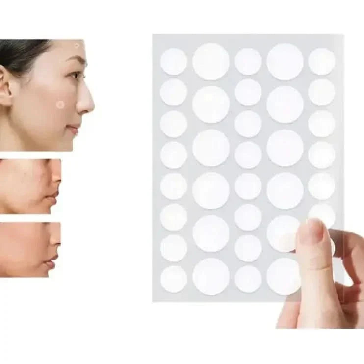 Fast Acne Spot Treatment Patches (72 Count) - Mycosmeticslondon