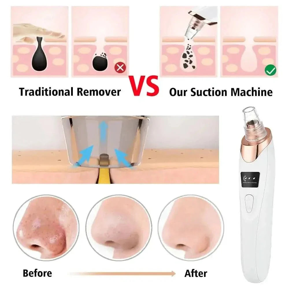 Pore Cleansing Facial Vacuum - Acne Spot Remover Tool