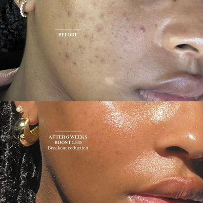 Brightening LED Face Mask | Advanced Skin Renewal