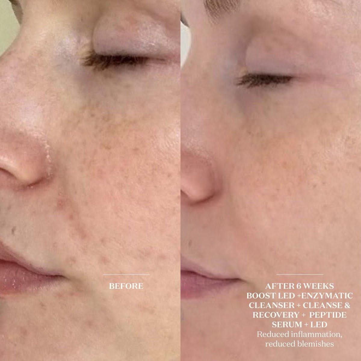 Brightening LED Face Mask | Advanced Skin Renewal
