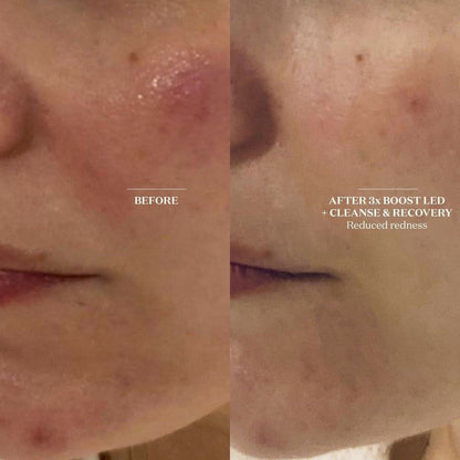 Brightening LED Face Mask | Advanced Skin Renewal