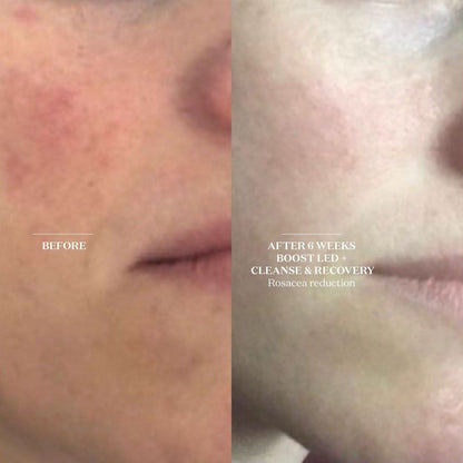 Brightening LED Face Mask | Advanced Skin Renewal