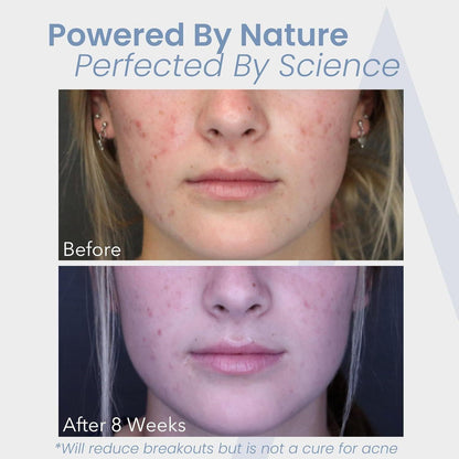 Natural Acne Relief Supplement - 60 Capsules