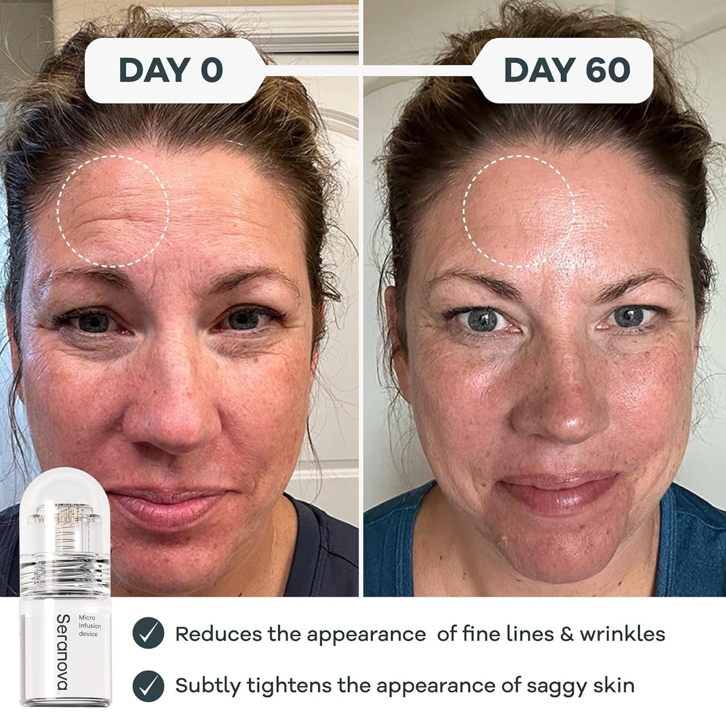 Advanced Microneedle Skincare Set - Hydrating Facial Treatment