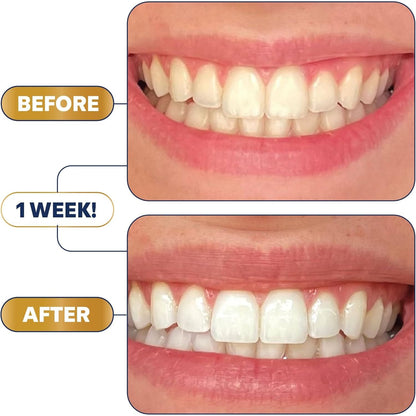 Effective At-Home Teeth Whitening Strips Kit