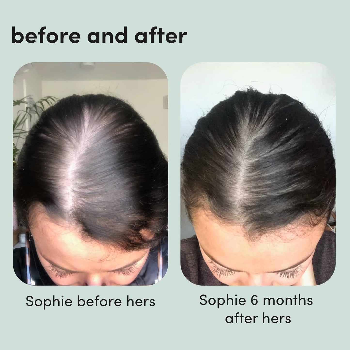 Women's Hair Growth Foam Treatment 5% Minoxidil