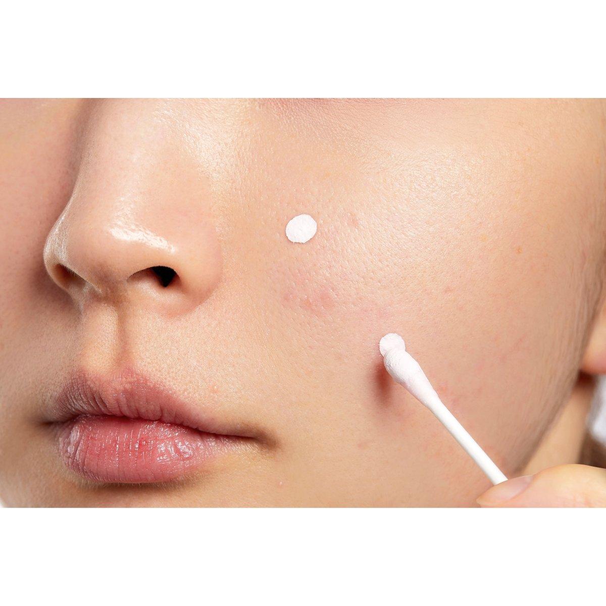 Effective Acne Spot Treatment Lotion
