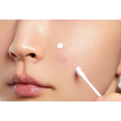 Effective Acne Spot Treatment Lotion
