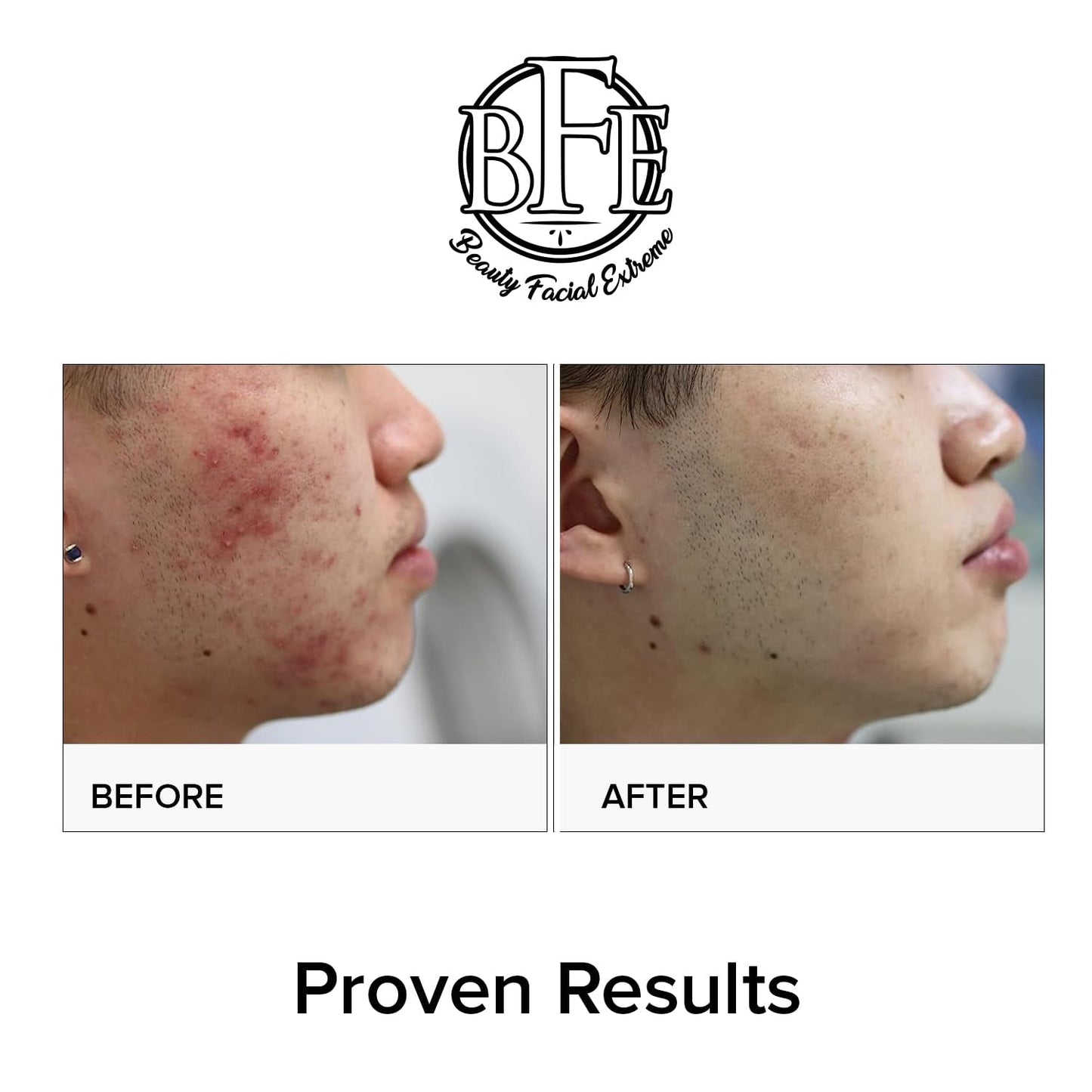 Effective Acne Treatment Pads with Salicylic Acid
