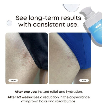 Gentle Ingrown Hair Serum for Sensitive Skin
