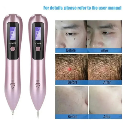 Easy Skin Tag & Tattoo Remover Pen