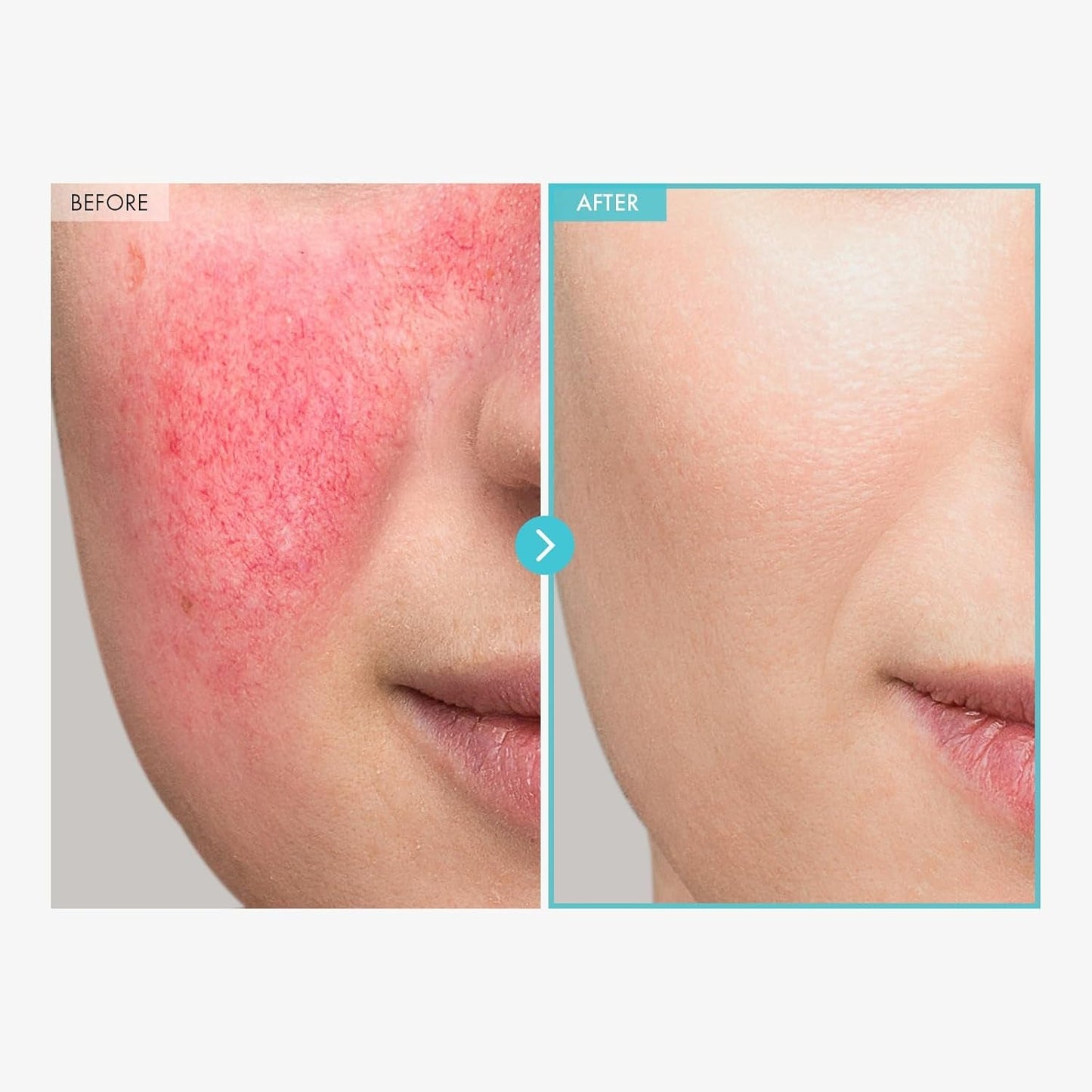 Soothing Acne Relief Face Cream with Zinc 50g