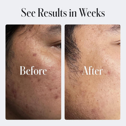 Natural Face Moisturizer Cream with SPF and Acne Control