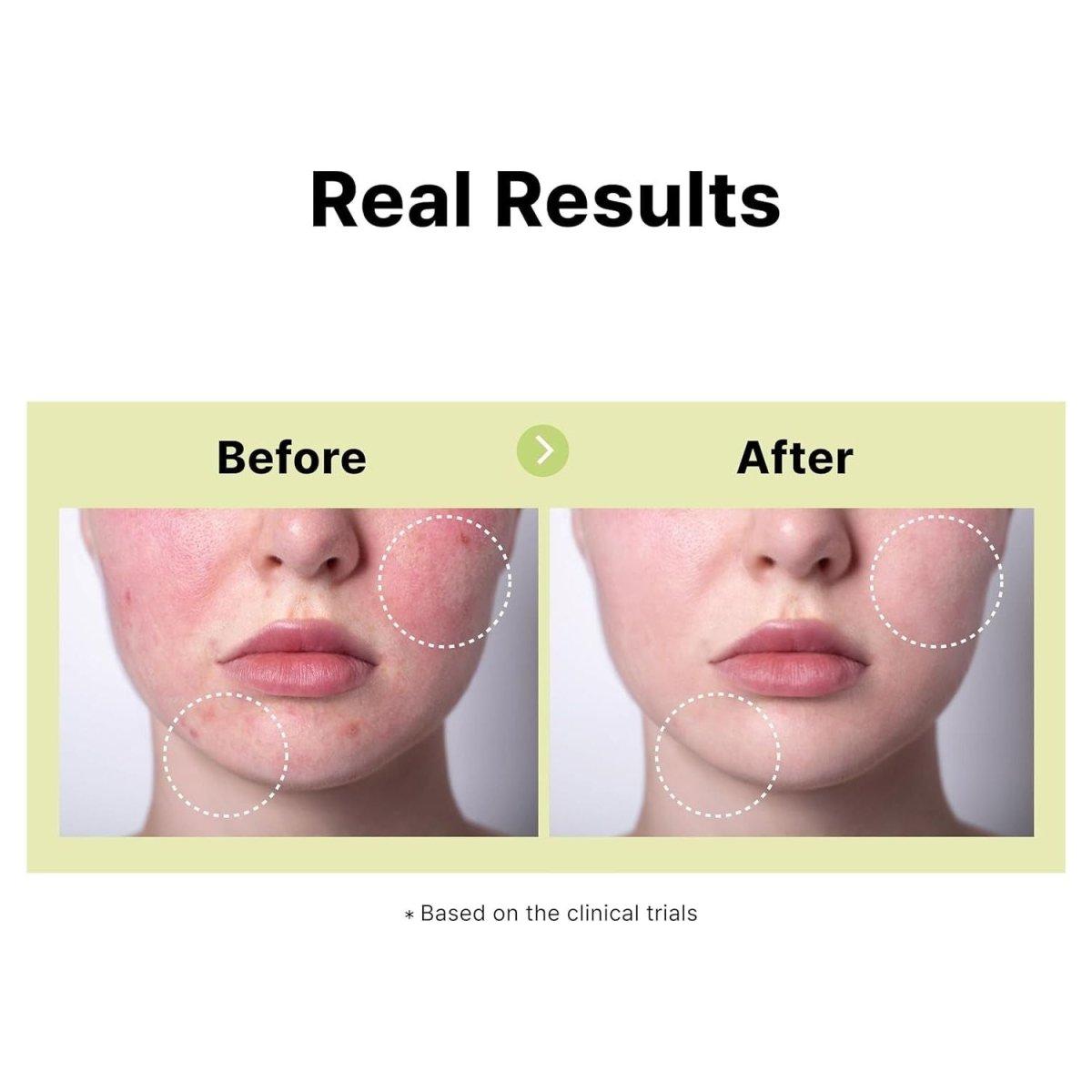 Natural Acne Treatment Serum 10% Azelaic Acid