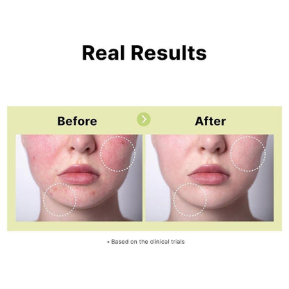 Natural Acne Treatment Serum 10% Azelaic Acid
