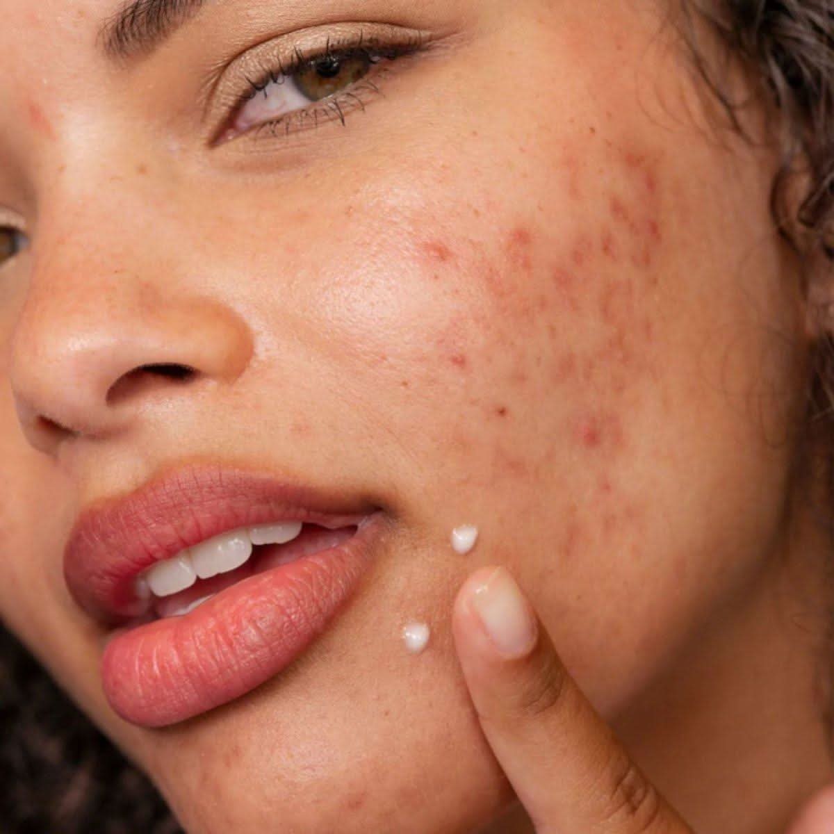 Acne Spot Treatment Fade Serum 15ml