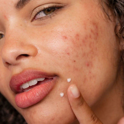 Acne Spot Treatment Fade Serum 15ml