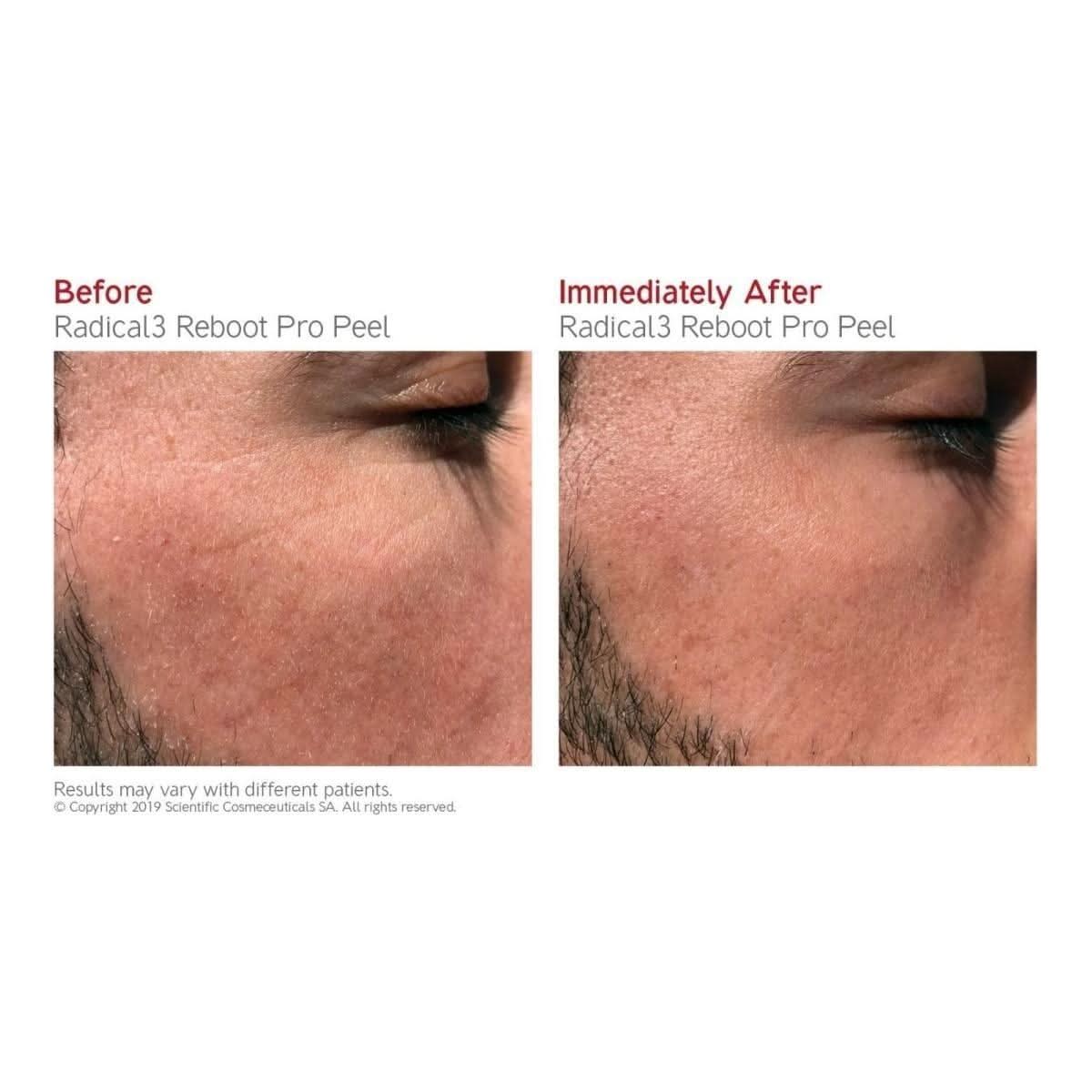Gentle Exfoliating Facial Peel Serum 50ml