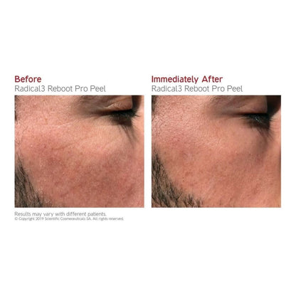 Gentle Exfoliating Facial Peel Serum 50ml