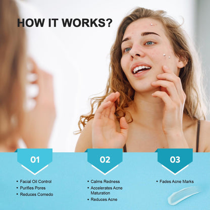Natural Acne Treatment Gel Cream with 10% Azelaic Acid