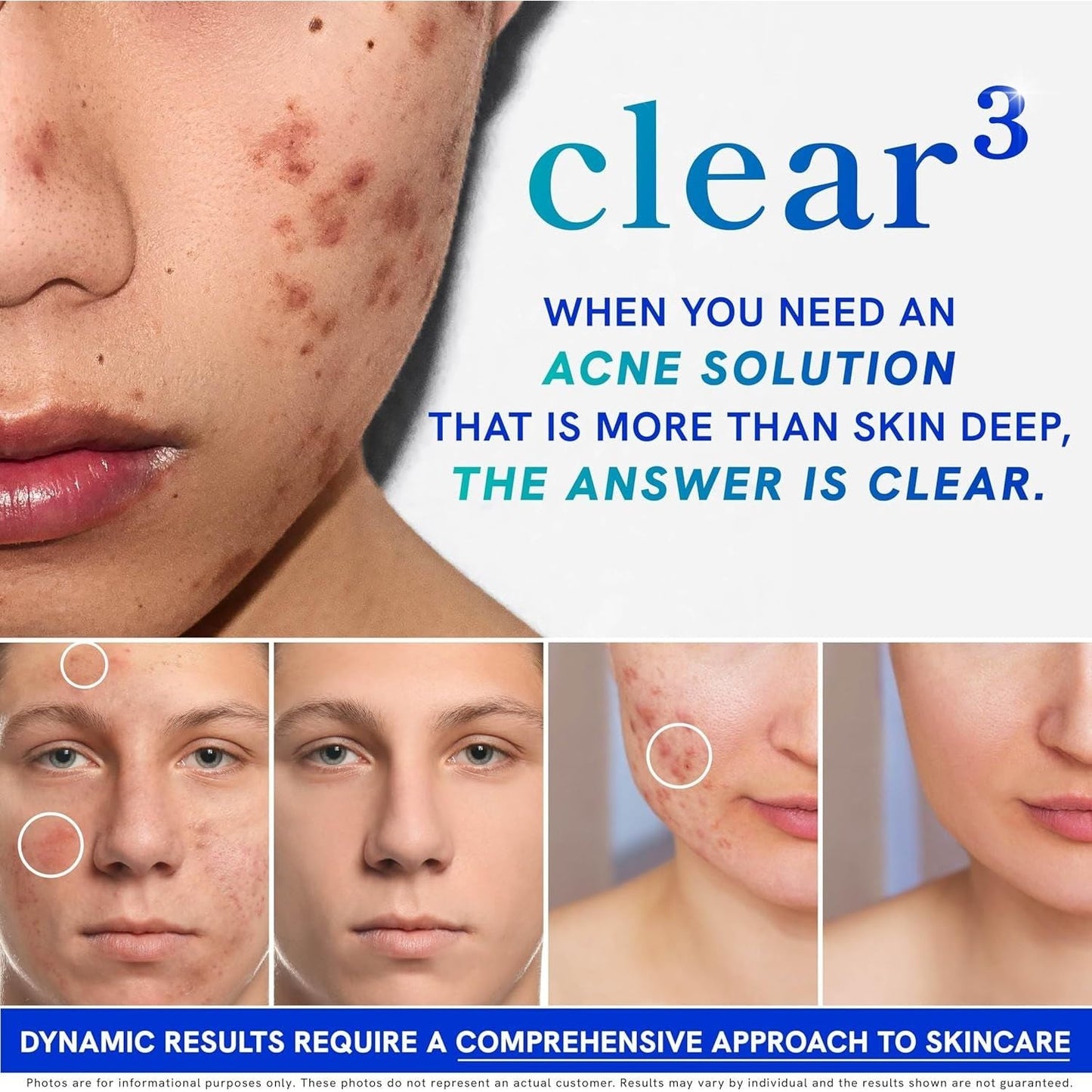 Natural Acne Relief Supplement - 120 Capsules