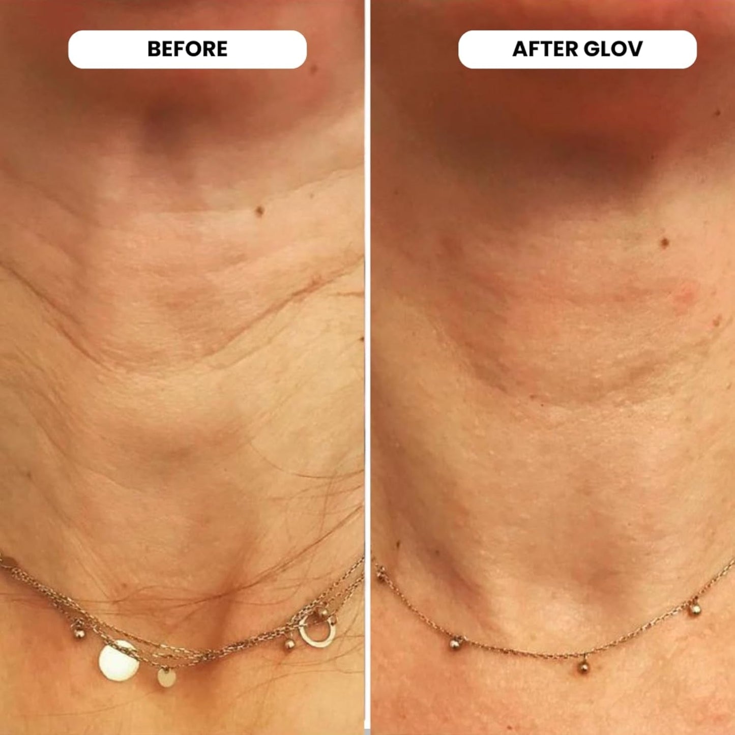 Advanced Skin Micro Infusion Kit with 4 Refills
