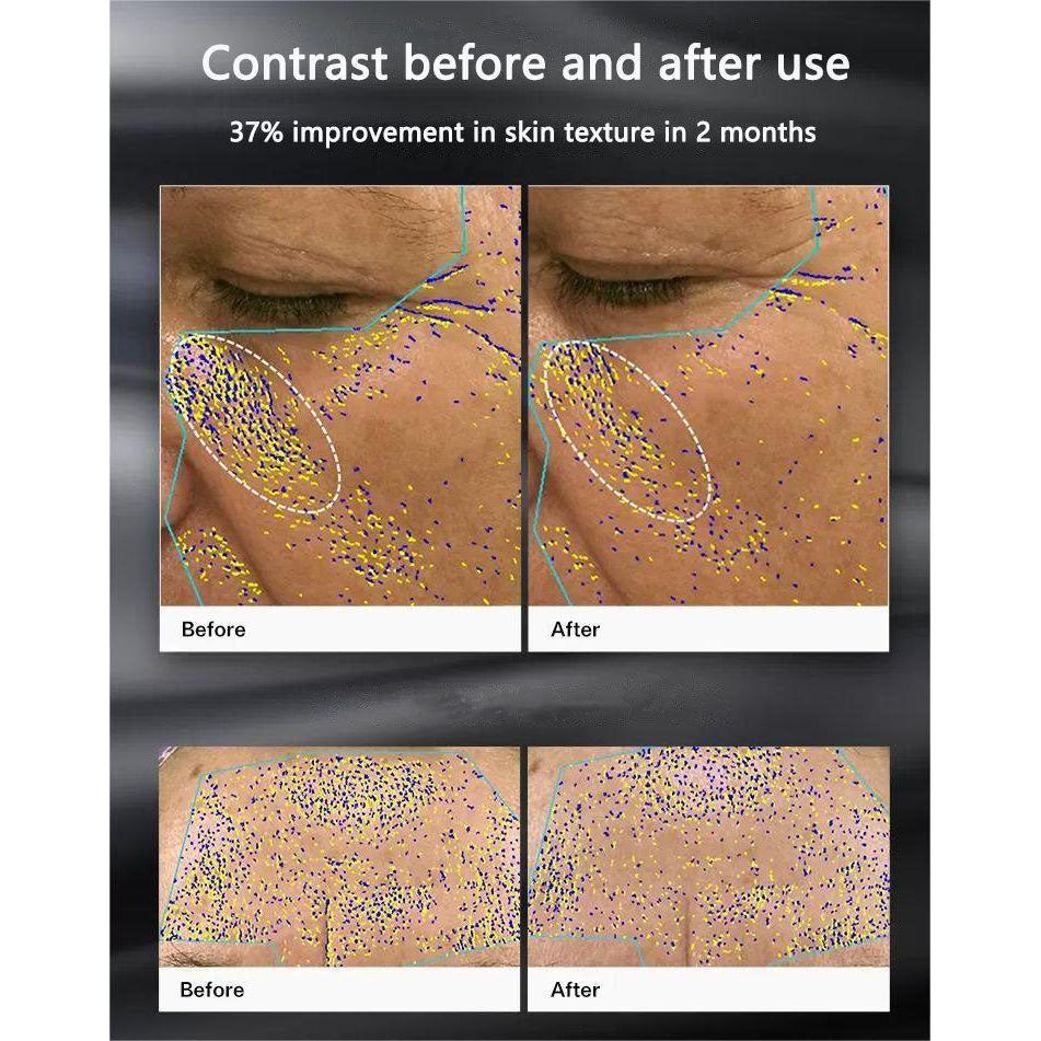 Professional RF Facial Skin Rejuvenation Device
