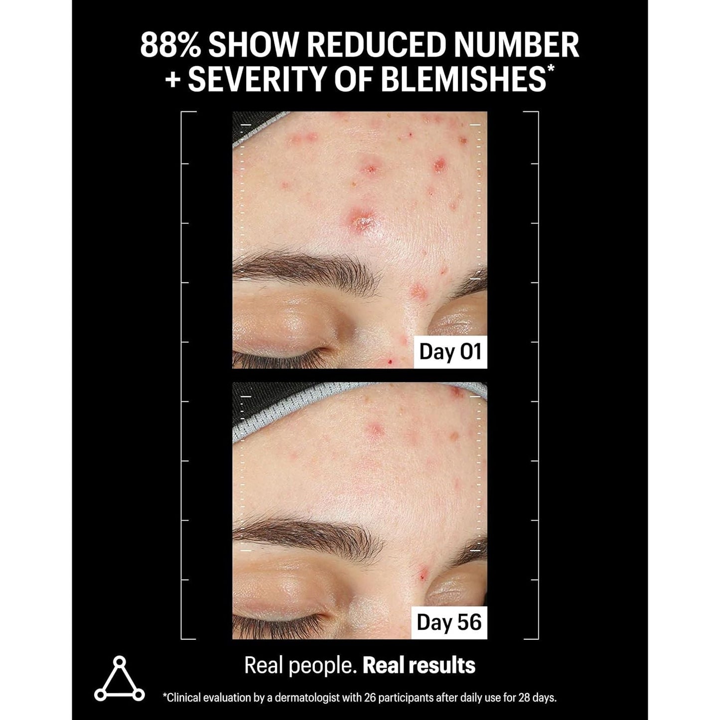 Powerful Azelaic Acid Skin Clarifying Serum 30ml