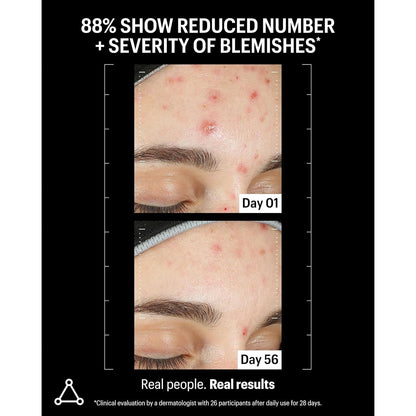 Powerful Azelaic Acid Skin Clarifying Serum 30ml