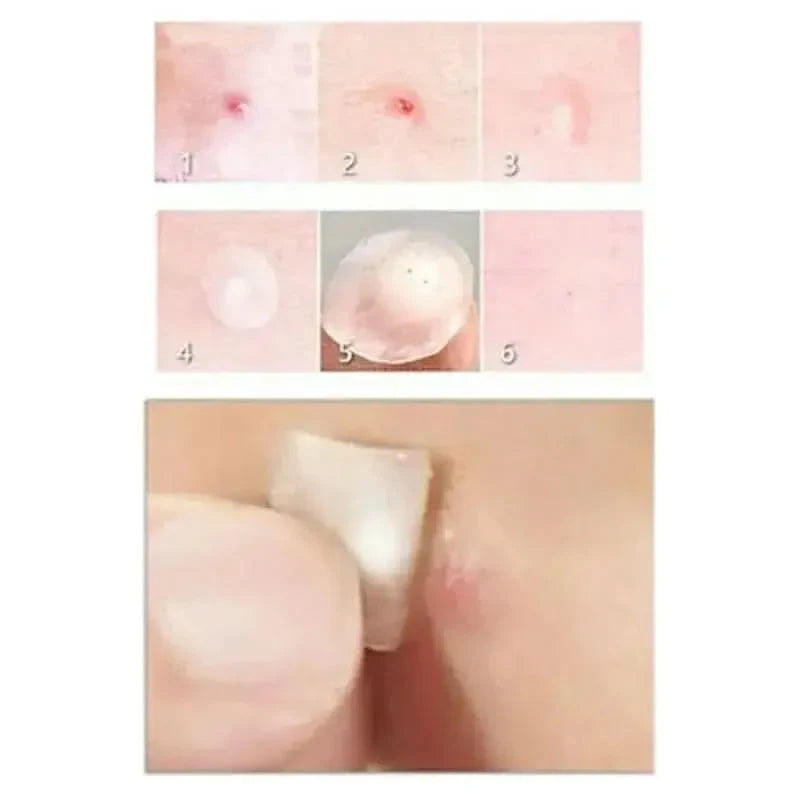 Acne Spot Blemish Care Repair Stickers