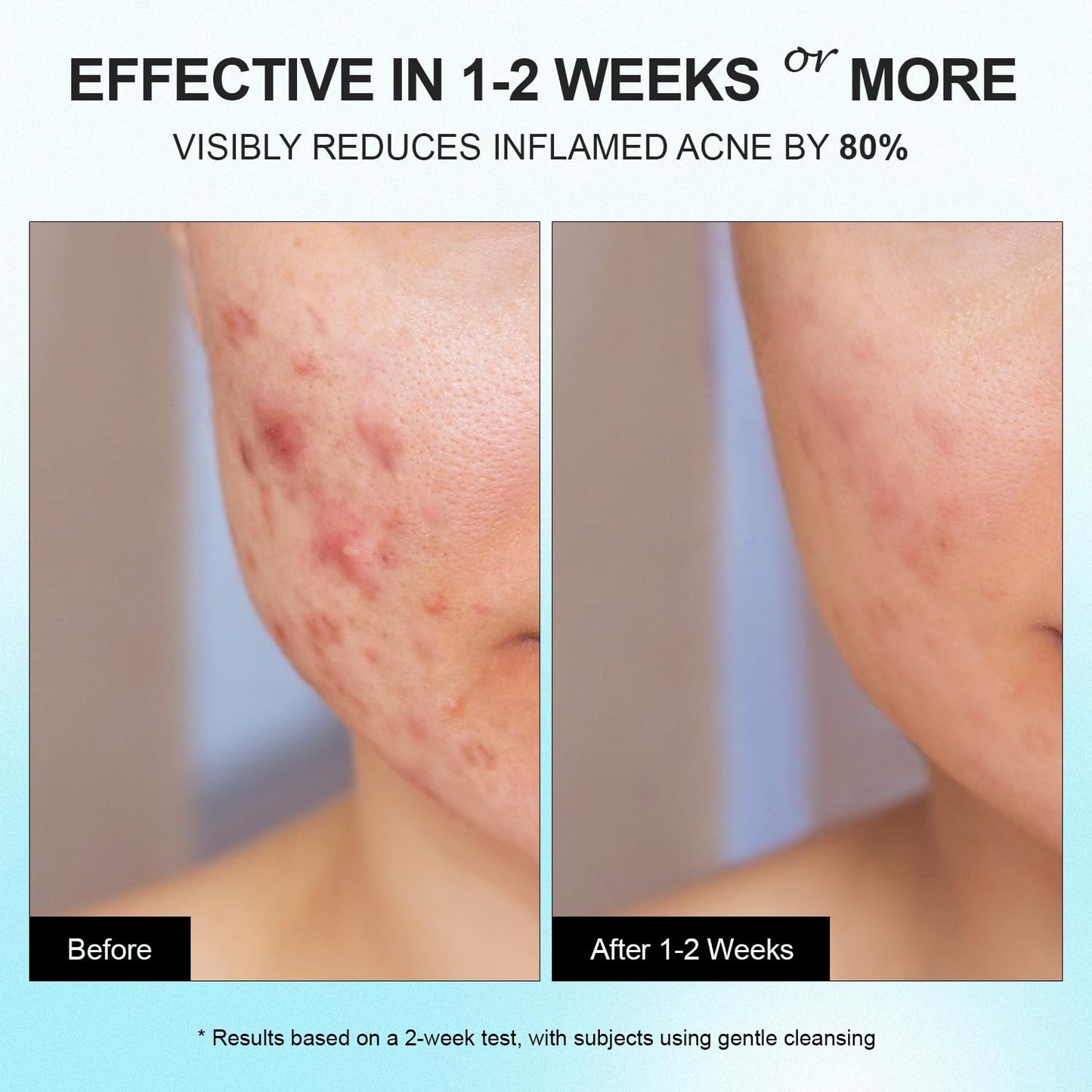 Natural Acne Treatment Gel Cream with 10% Azelaic Acid