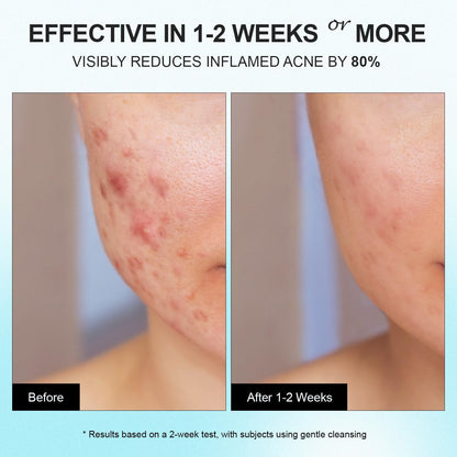 Natural Acne Treatment Gel Cream with 10% Azelaic Acid