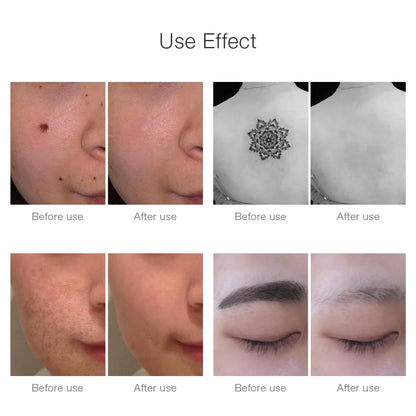 Portable Laser Spot Remover Pen for Dark Spots & Moles