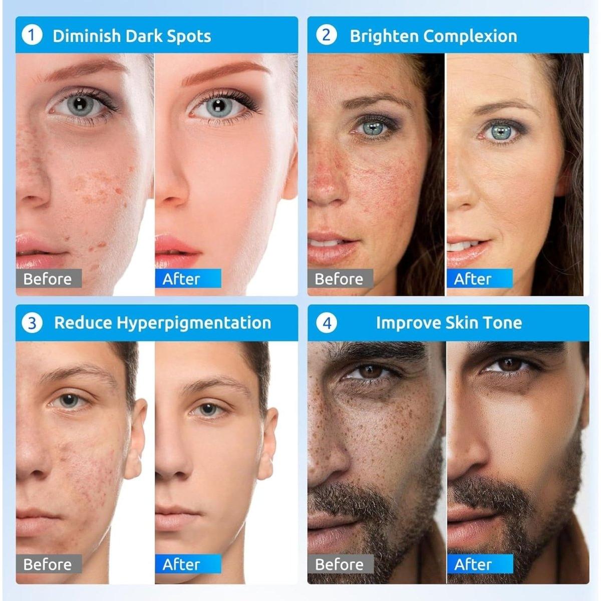 Effective Dark Spot Remover Face and Body Cream