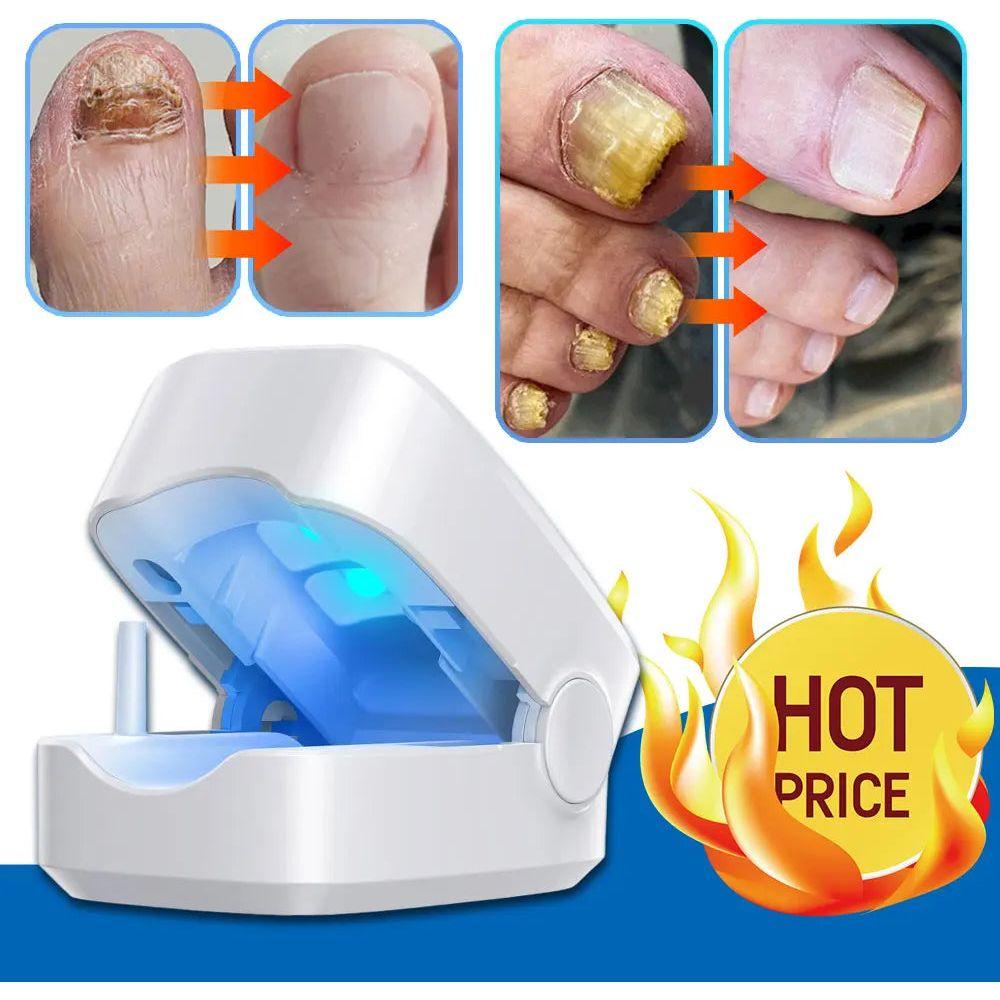Easy At Home Nail Fungus Removal Tool