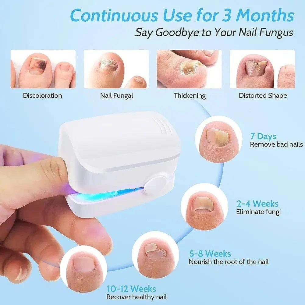 Easy At Home Nail Fungus Removal Tool