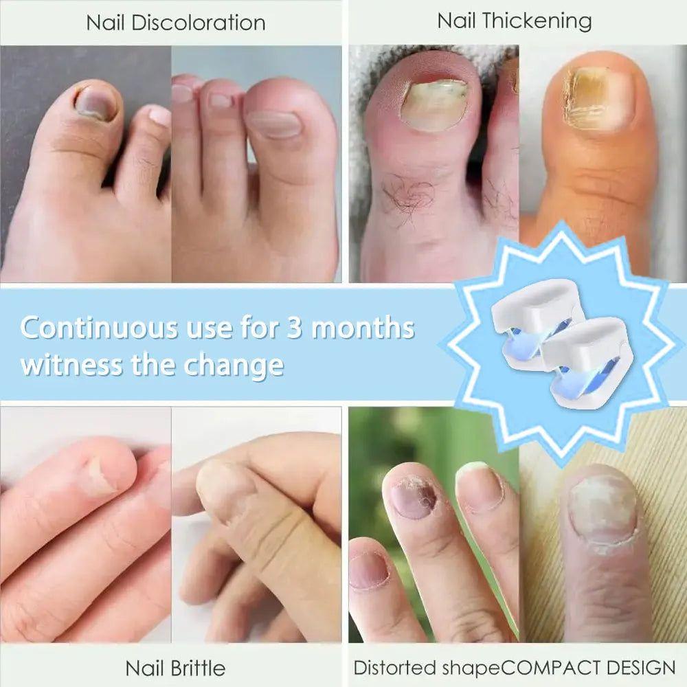 Easy At Home Nail Fungus Removal Tool