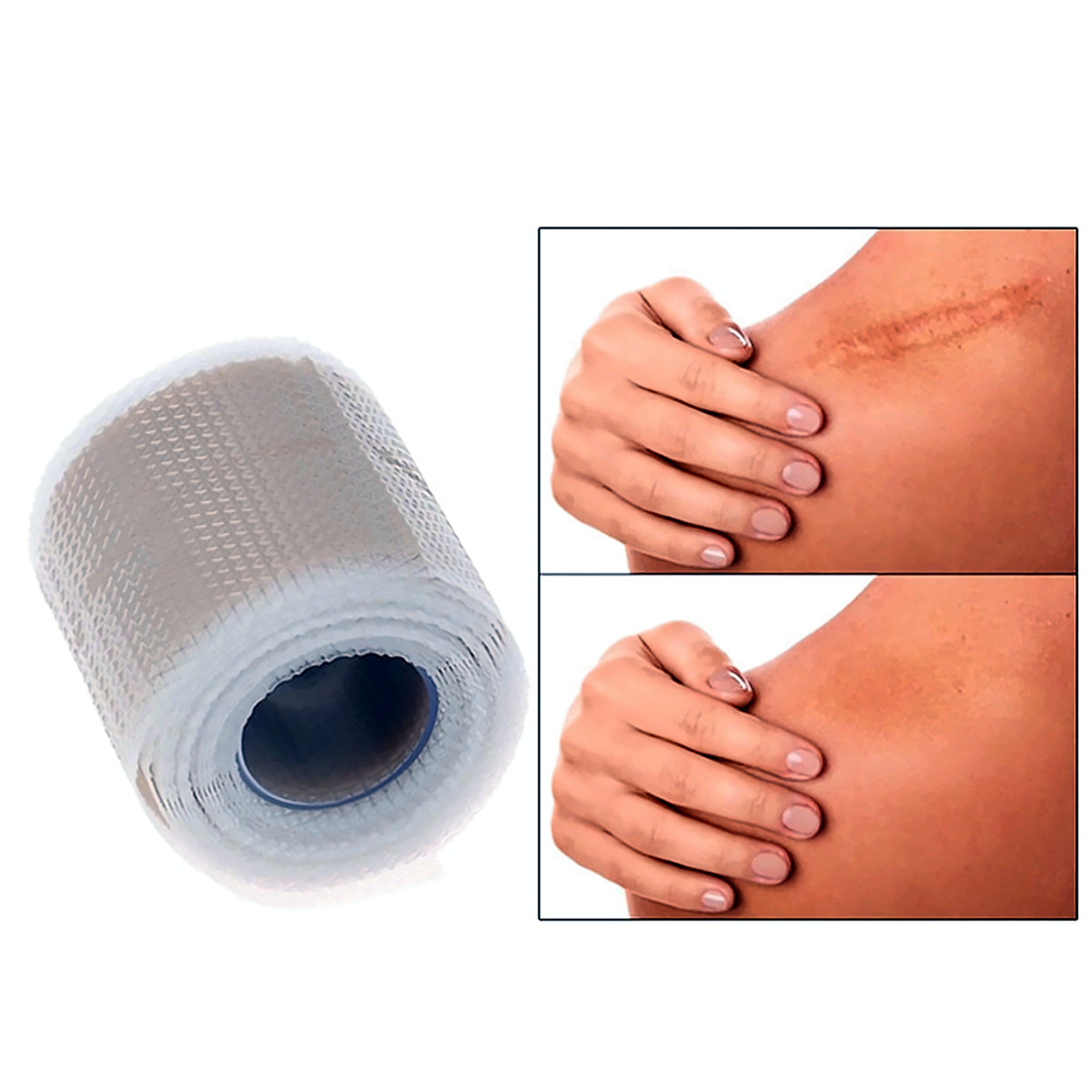 Silicone scar tape roll and application on the shoulder
