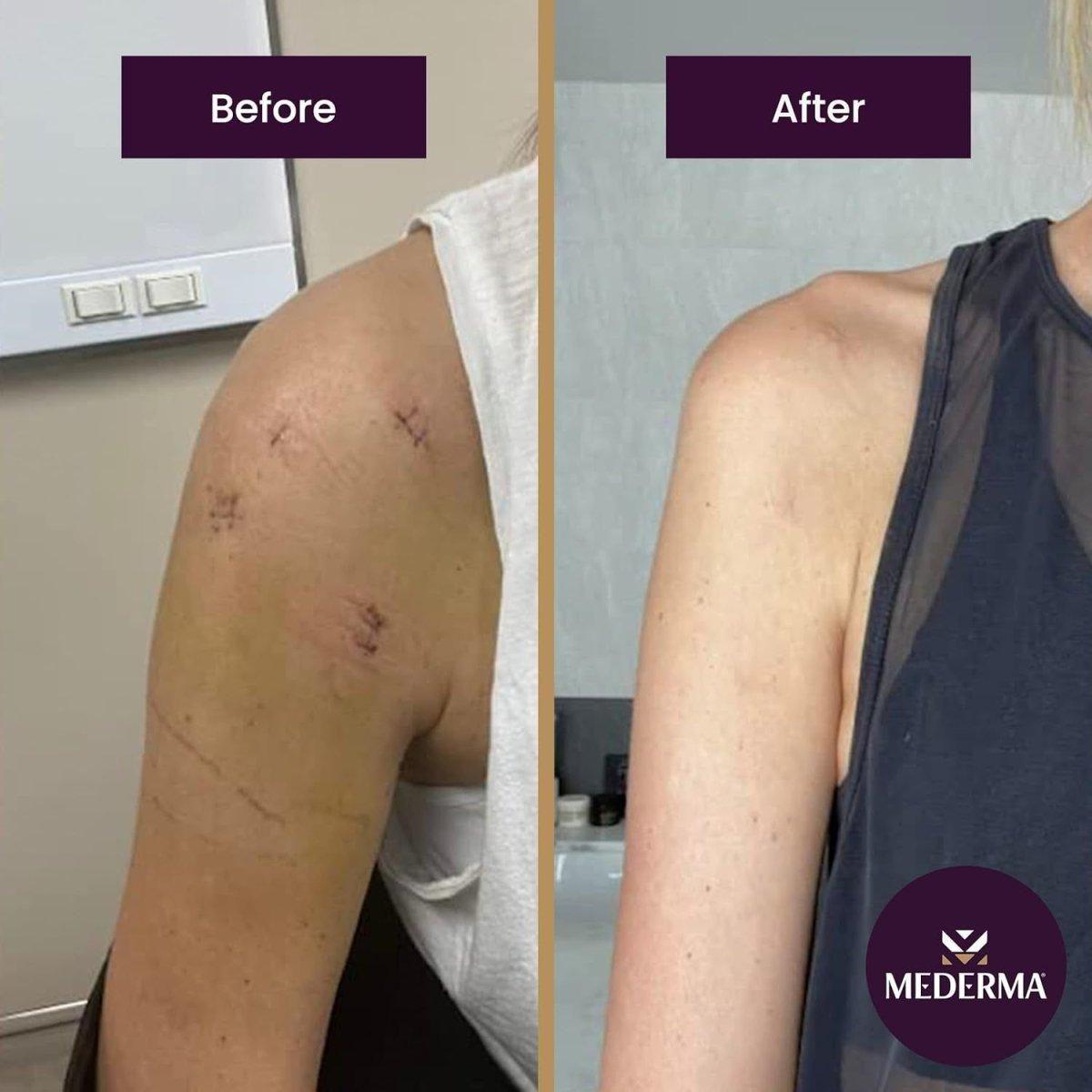 Effective Scar Removal Gel for Acne and Burn Scars