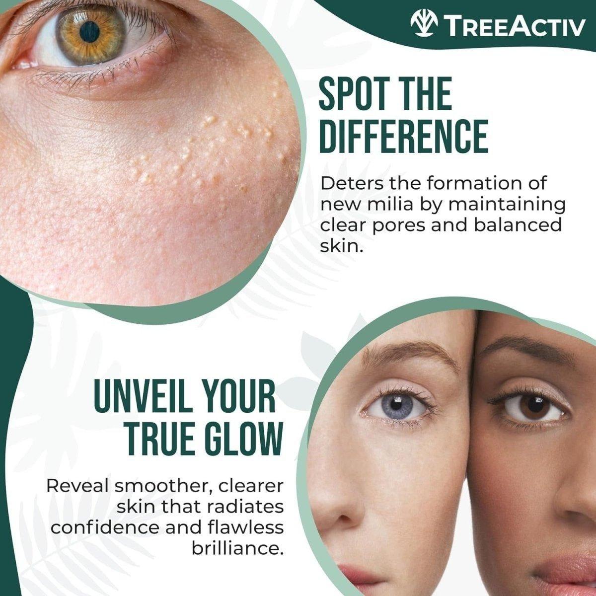 Effective Spot Cream for Acne and Milia Removal