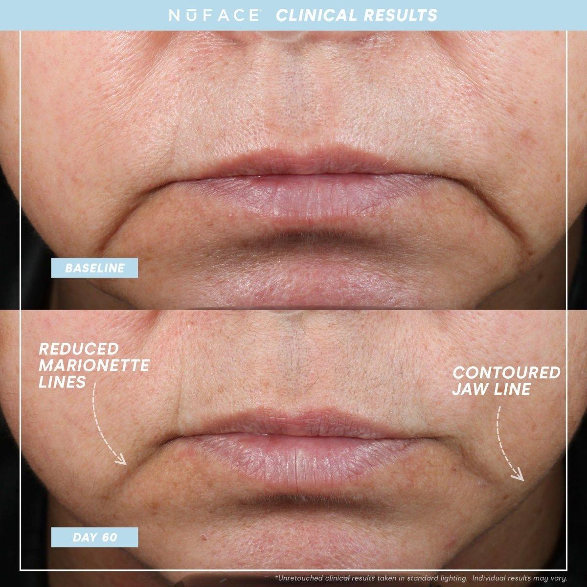 Compact Anti Aging Facial Toner Device Kit