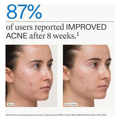 Natural Acne Relief Supplements for Women - 120 Capsules