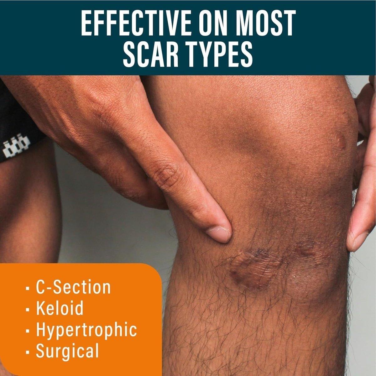 Effective Scar Remover Gel with Retinol and Silicone