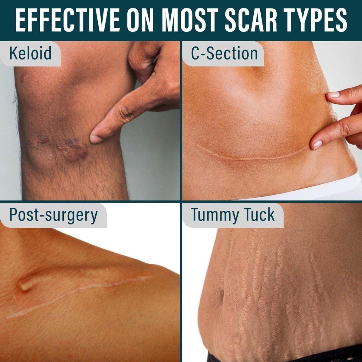 Gentle Silicone Scar Healing Tape - 1 Pack