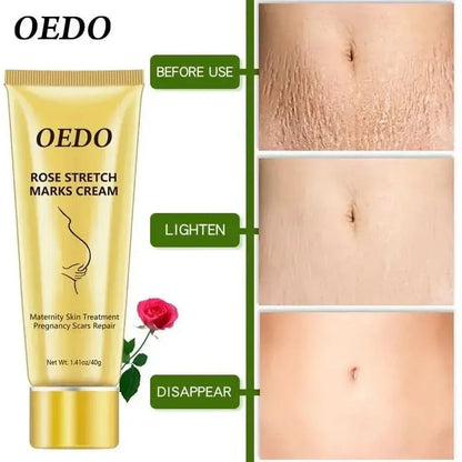Best Stretch Mark Removal Cream for Glowing Skin - Mycosmeticslondon